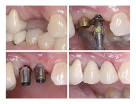 Dental Implants